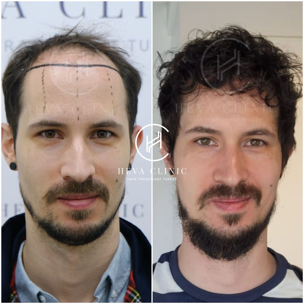 Discover FUE Hair Transplant: Benefits and Costs Explained 2024