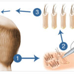 Discover FUE Hair Transplant: Benefits and Costs Explained 2024