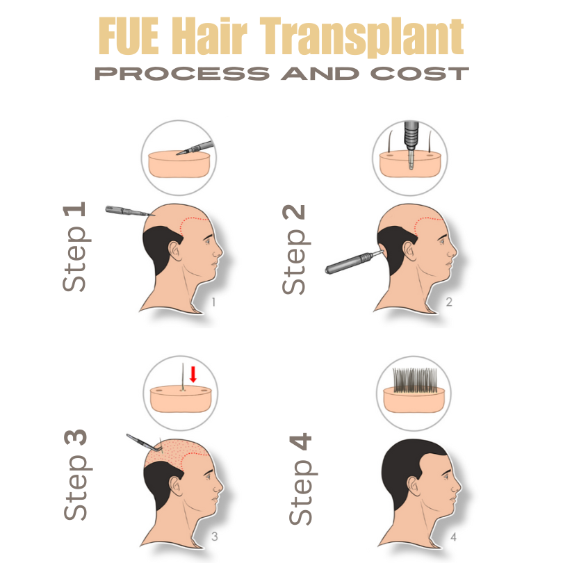 Discover FUE Hair Transplant: Benefits and Costs Explained 2024