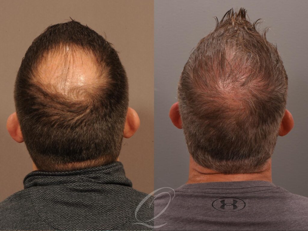 Discover FUE Hair Transplant: Benefits and Costs Explained 2024